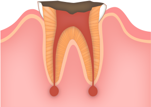 歯を抜かない為の治療