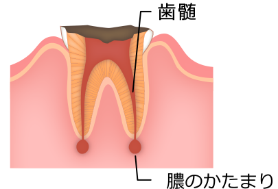 歯根のう胞