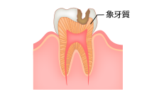 歯の内面の虫歯