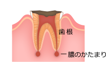 歯の神経まで達した虫歯