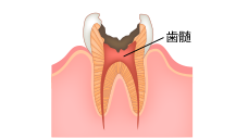 歯の根本だけ残る虫歯